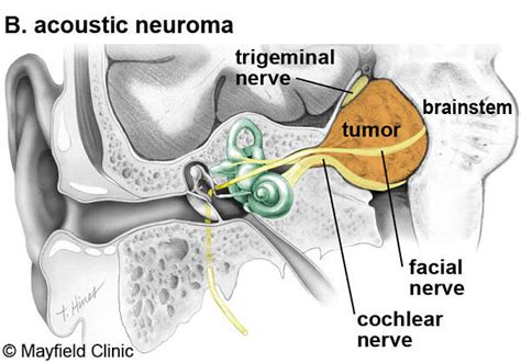 gianni versace acoustic neuroma|acoustic neuroma in humans.